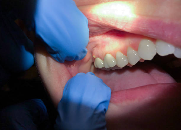 Best Broken or Chipped Tooth Repair in East Lake Orient Park, FL